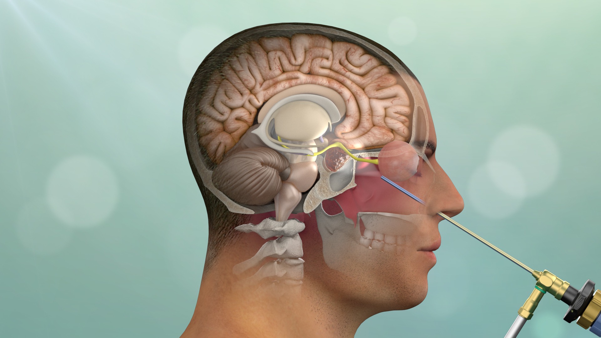 Endonasal Pituitary Surgery 1 14 190 SAINT JOHNS KEYHOLE SURGERY ENDONASAL Adenoma1 1 - Endonasal Pituitary Surgery - Endonasal Pituitary Surgery