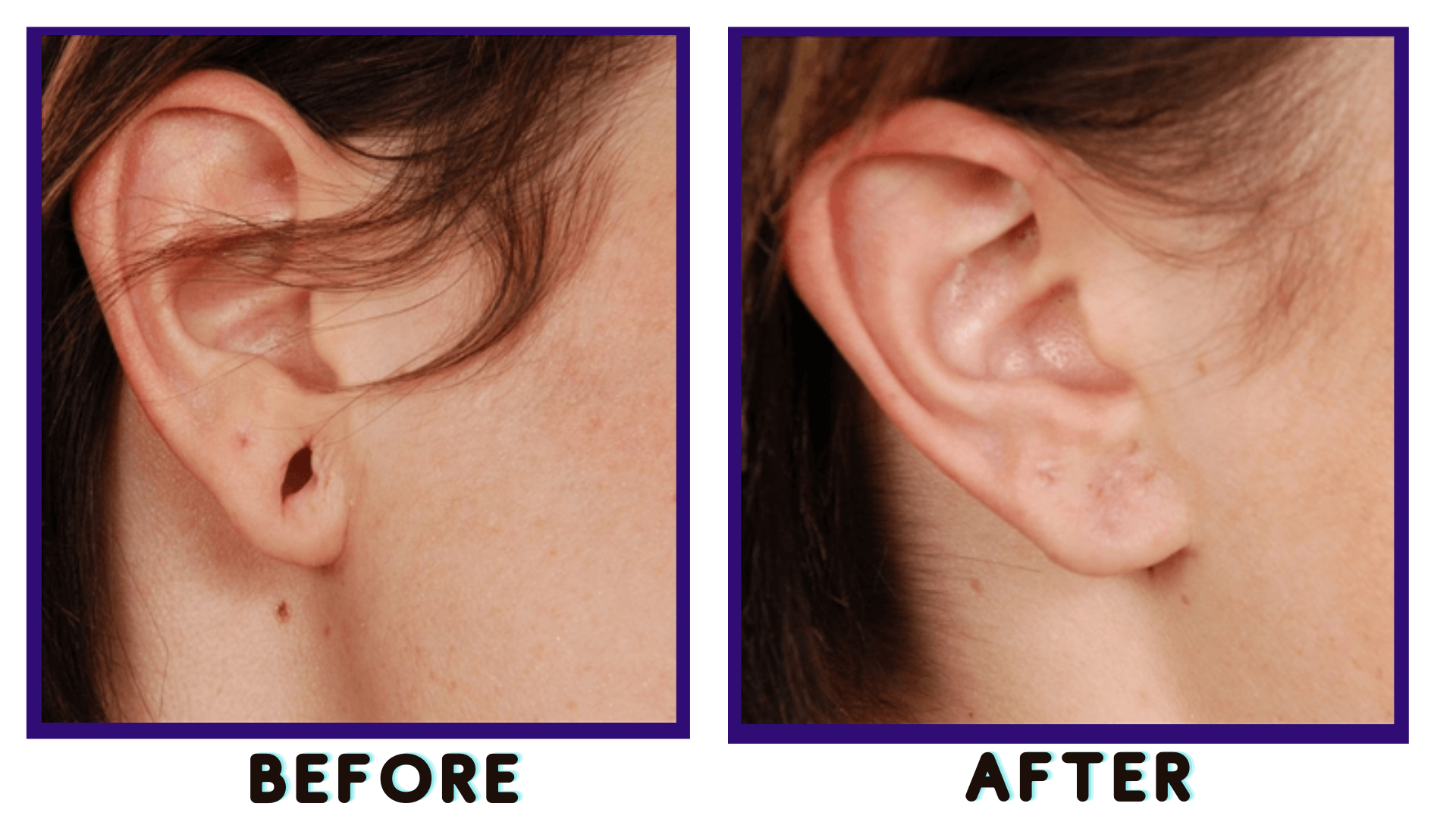 Earlobe Repair 1 earlobe repair surgery before and after - Earlobe Repair - Earlobe Repair