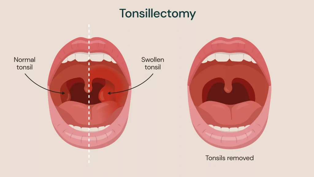What to Expect During a Tonsillectomy: A Complete Guide