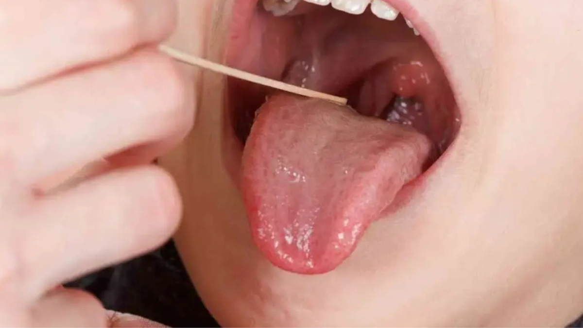 What to Expect During a Tonsillectomy: A Complete Guide