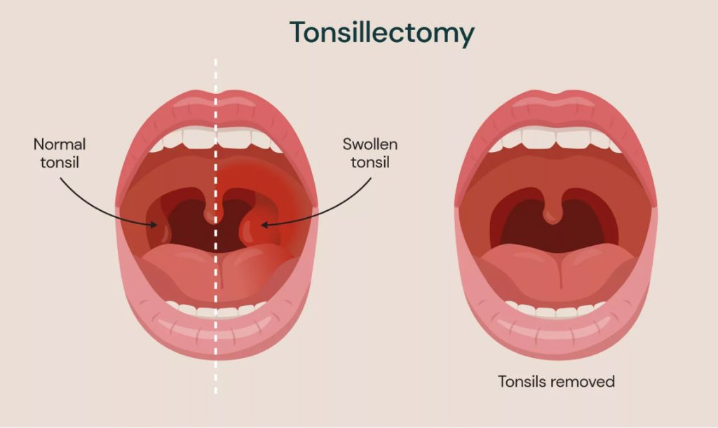 Blog Images 4 01 - What to Expect During a Tonsillectomy: A Complete Guide -