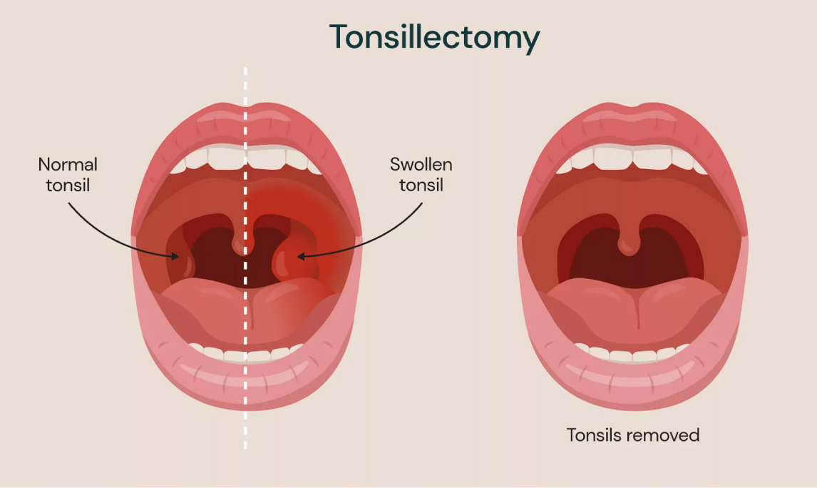 What to Expect During a Tonsillectomy: A Complete Guide