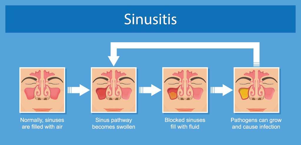 Sinusitis Treatment in Indore 1 chronic sinusitis illustration - Sinusitis Treatment in Indore - Nose Specialist