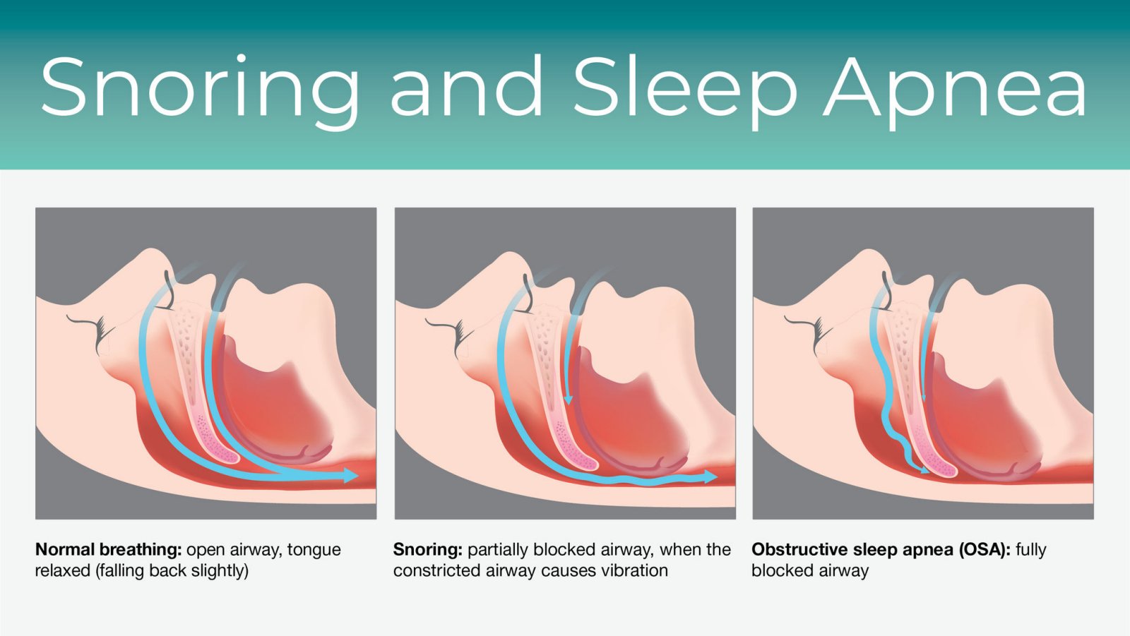 Sleep Apnea & Snoring Treatment in Indore 1 gl 2765544 01 1552x874 1 - Sleep Apnea & Snoring Treatment in Indore - Nose Specialist