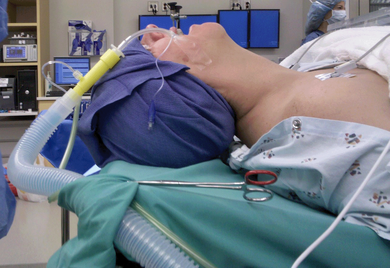 Microlaryngoscopy: Procedure Details and Recovery