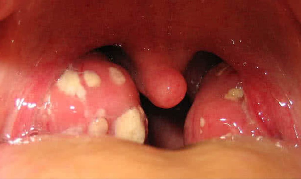 Blog Image 7 01 - Persistent Sore Throat or Hoarseness? It Could Be More Than a Cold -