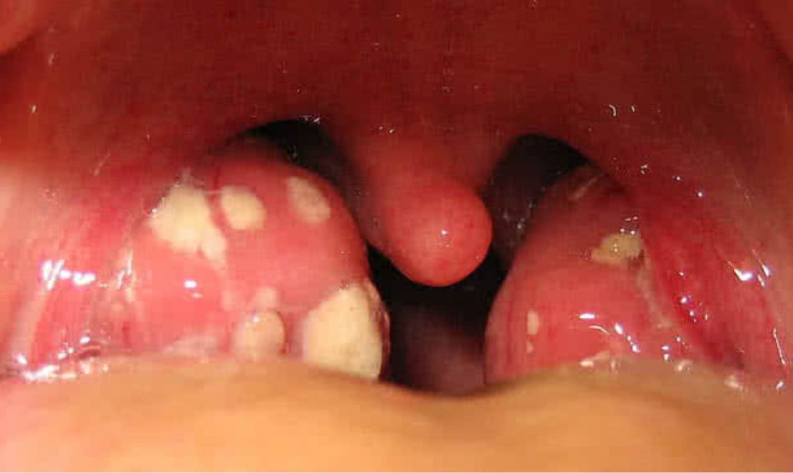 Persistent Sore Throat or Hoarseness? It Could Be More Than a Cold