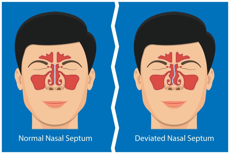 Illustration comparing normal vs. deviated nasal septum - Septoplasty and Beyond: When Nose Surgery Becomes a Necessity -