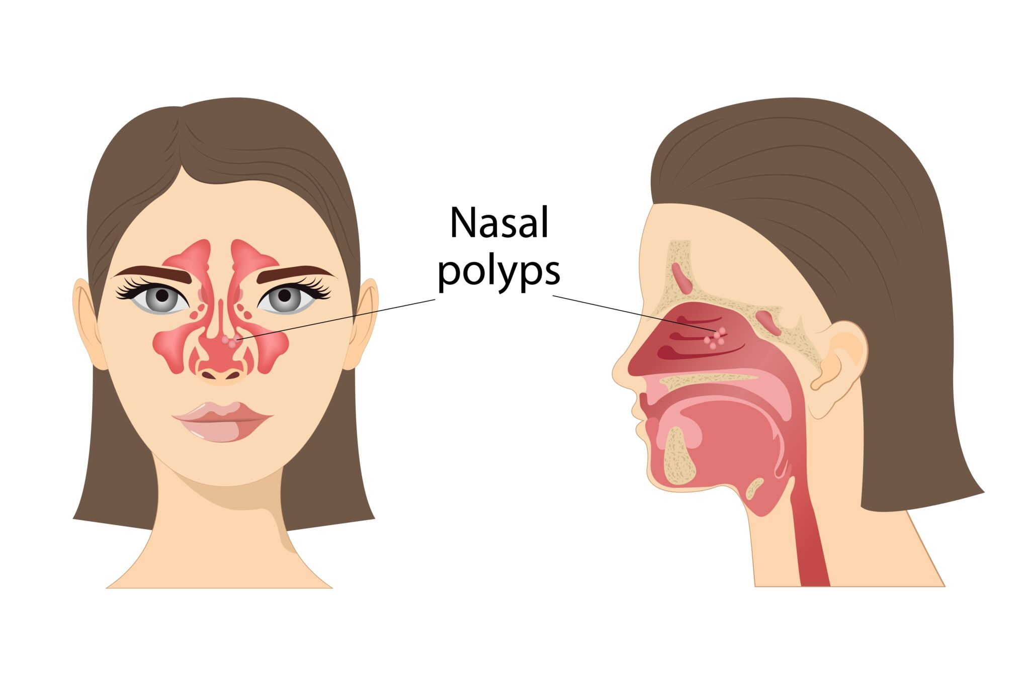 Breathing Trouble? Learn About Nasal Polyps and How to Treat Them
