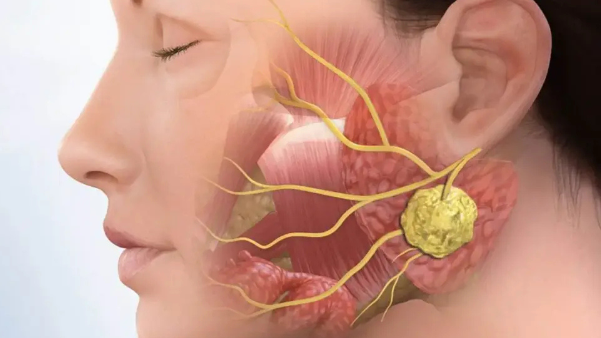 Salivary Gland Lesions: Symptoms, Diagnosis & Treatment Options