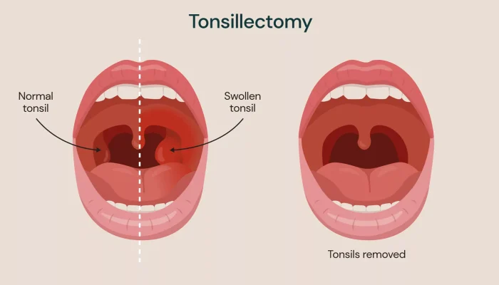 284_RBH_Illustration_Tonsillectomy_v1 284_RBH_Illustration_Tonsillectomy_v1